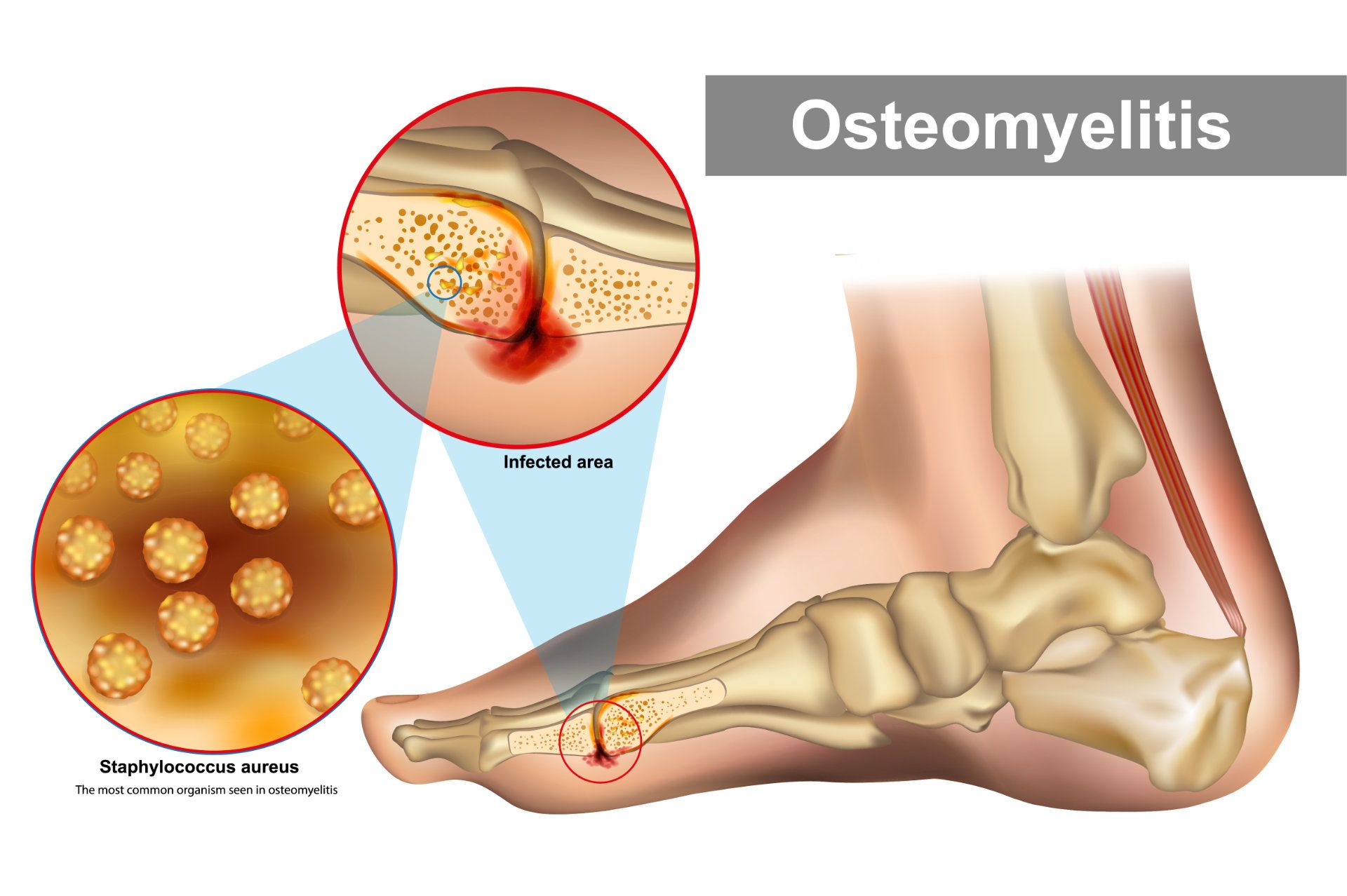 Osteomyelitis Graphic